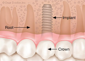Full crown placed on dental implant.