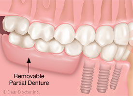 Removable partial denture.