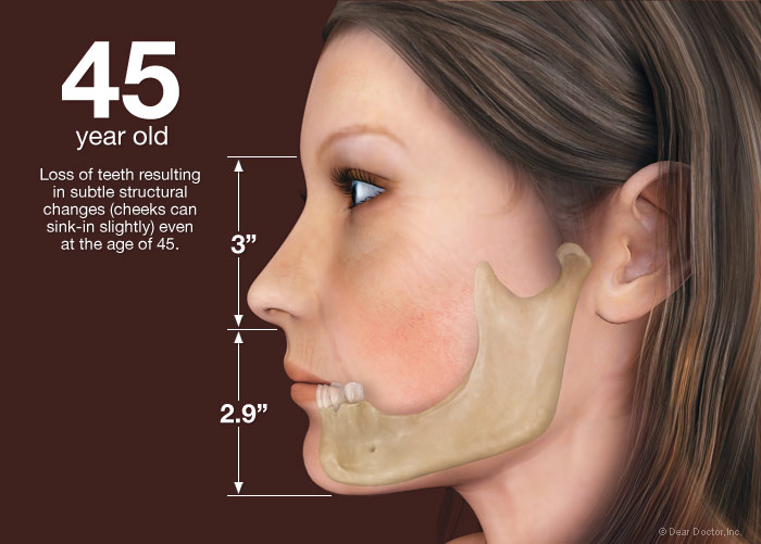 Facial Bone Loss 37
