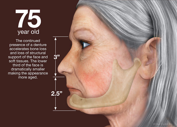 Facial Bone Loss 101