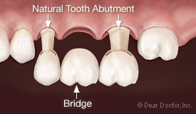 Dental bridge.