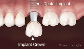 Dental implant crown.