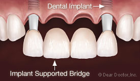 Dental implant supported bridge.
