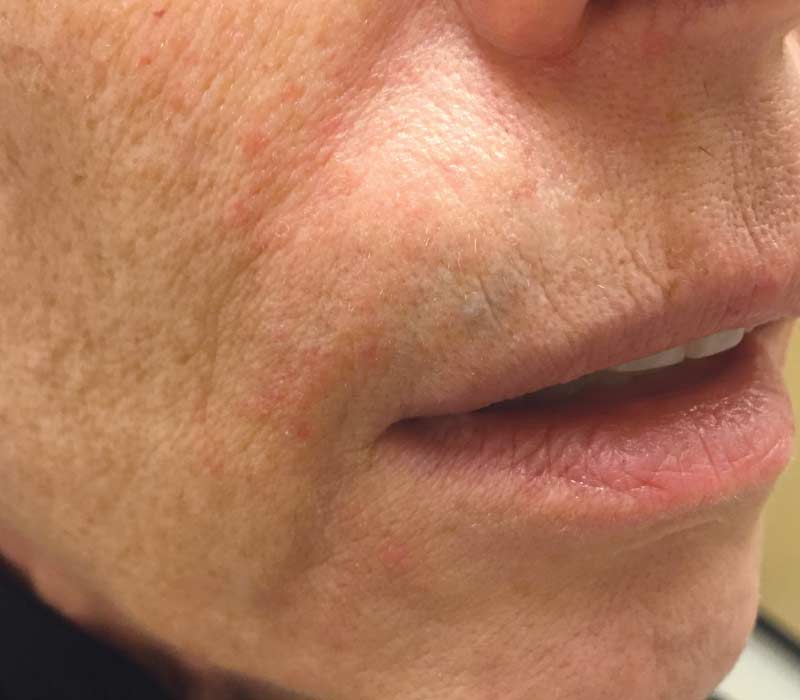 Perioral Dermatitis - Healthline