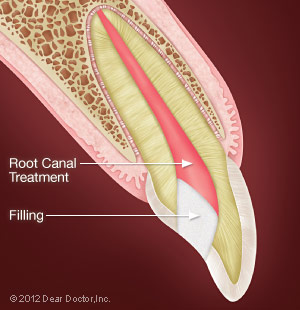 Root Canal Procedure.