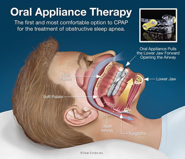 Oral Sleep Appliance 73