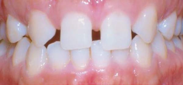 Before clear aligner treatment.