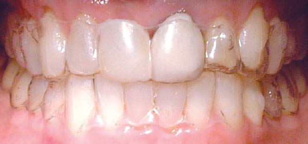 Clear aligner temporary tooth.