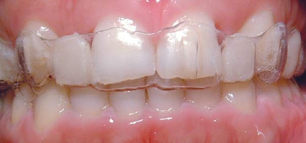 Clear aligner treatment.
