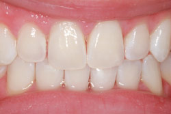 After teeth whitening.