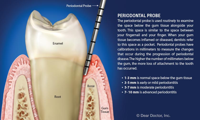 Understanding Periodontal Pockets