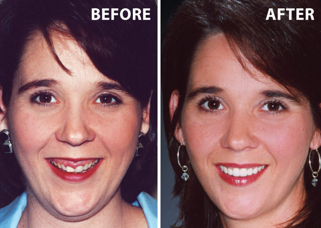 [Image: gummy-smile-before-and-after.jpg]