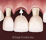 Crowns and Bridges: Two Paths to Tooth Restoration