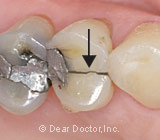 What You Need to Know About Saving Your Cracked Tooth