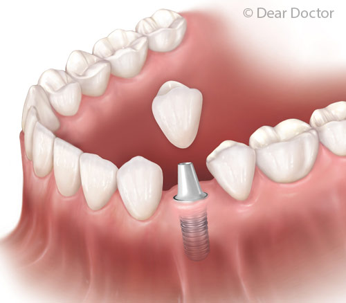 3 Reasons Why You Shouldn’t Be Nervous About Implant Surgery