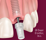 What is a Dental Implant?