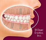 Dental Implants—Your Third Set of Teeth