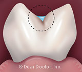 Protecting Your Child’s Teeth with Sealants