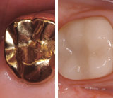 Gold or Porcelain, Which Crown Is Right for You?