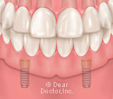 A New Standard of Care: Lower Jaw Implant