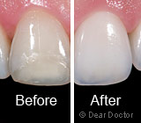Enhancing Your Smile with Porcelain Veneers