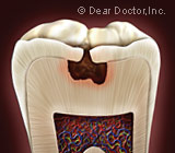What Do You Do About a Severe Toothache