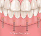 The Inexpensive Solution for Loose Dentures