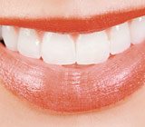Bleaching, an Effective Method for Whitening Teeth