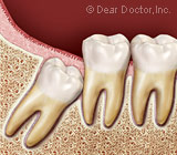 Wisdom Teeth