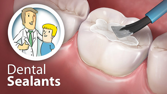 Dental Sealants Video