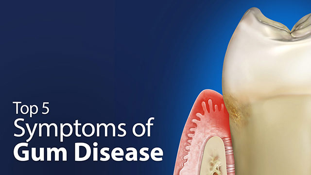 Top 5 Symptoms of Gum Disease Video