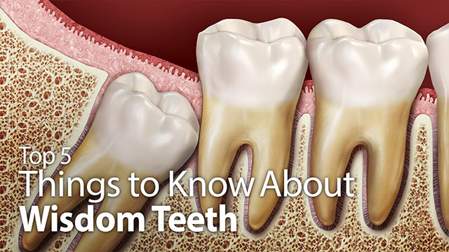 Top 5 Things to Know About Wisdom Teeth Video