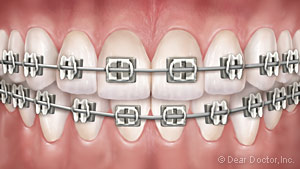 Metal braces