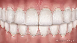 Clear Orthodontic Aligners.