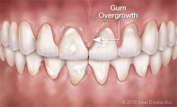 Gum Overgrowth.