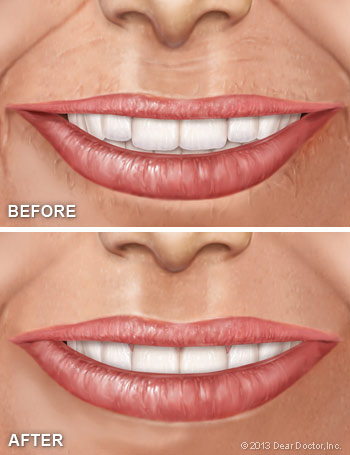 Cosmetic fillers before and after.