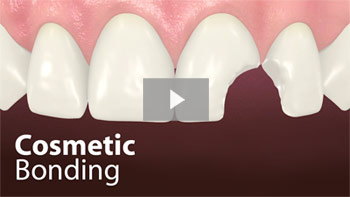 Cosmetic Bonding