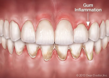 Gum inflammation.