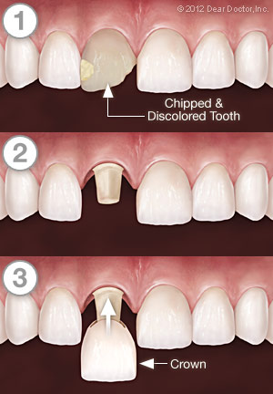 crowns bridgework capping dental crown step tooth crowning