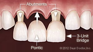 Dental Bridge.