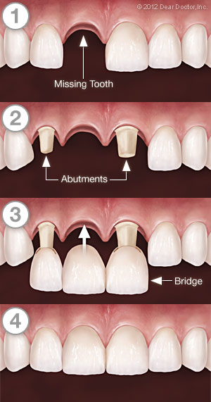 Dental Bridgework - Step by Step.
