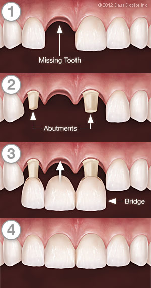 http://www.deardoctor.com/images/webcontent/dental-bridges/bridges-series.jpg