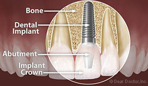 dental impants in clovis ca