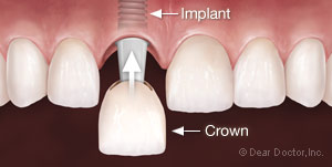 Dental Implant.