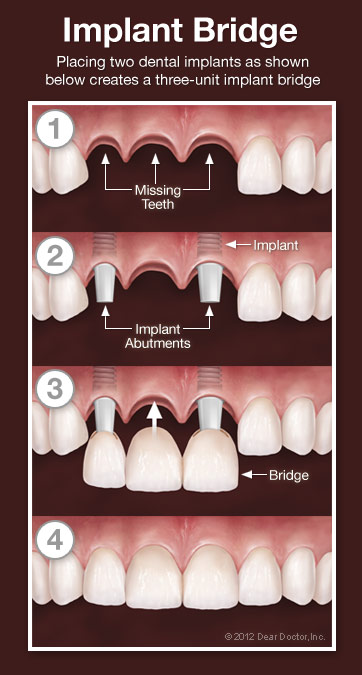  dental bridge replacement cost uk