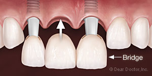 Dental Implant Bridge.