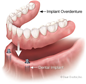 Implant-Supported Overdenture.