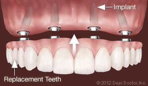 clovis ca dental implants