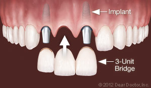 dental implants clovis