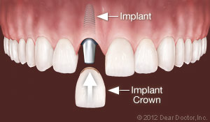clovis dental implants